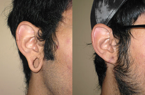 The Five-Minute Earlobe Fix - SkinCare Physicians