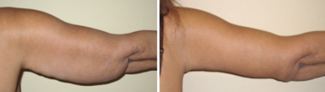 Solutions to Tighten Sagging Upper Arms