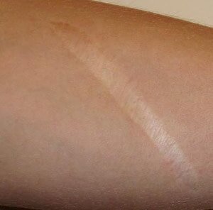 Substantial Scars SCARS AND PLASTIC SURGERY ORANGE COUNTY SCARS AND ORANGE COUNTY PLASTIC ...