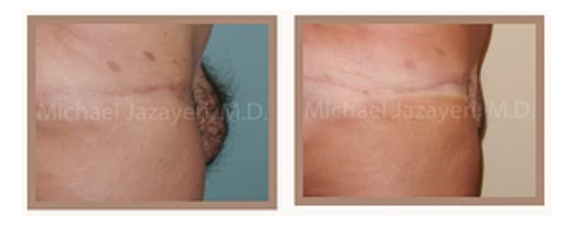GLADIATOR LIPOSUCTION AND REUVION FOR MALE SIX PACK AND MONS PUBIS FUPA  REDUCTION
