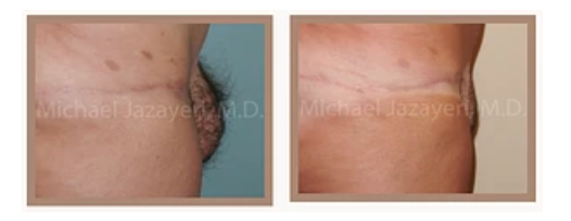 Pubic Lifts and Liposuction for Mons Rejuvenation - Explore