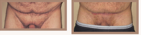 Liposuction of the FUPA (Mons)