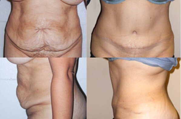 Tummy Tuck Surgery Types