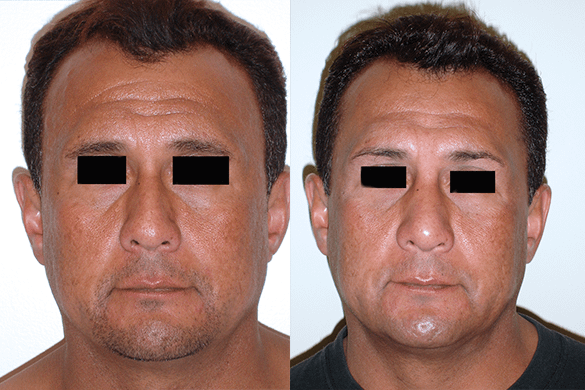 Rhinoplasty Before & After Photos Front