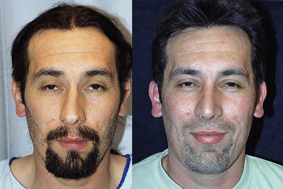 Rhinoplasty Before & After Photos Front