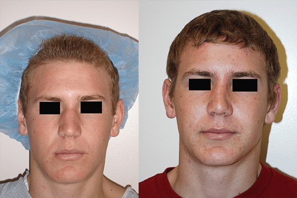 Rhinoplasty Before & After Photos Front