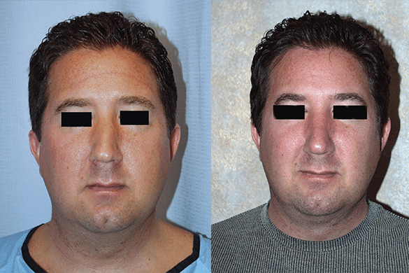 Rhinoplasty Before & After Photos