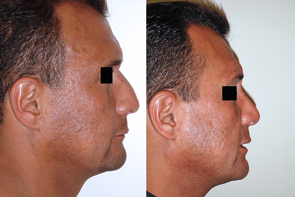 Rhinoplasty Before & After Photos Right