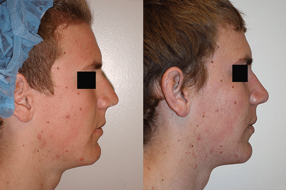 Rhinoplasty Before & After Photos Right