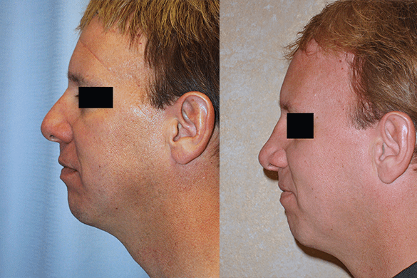 Rhinoplasty Before & After Photos Left