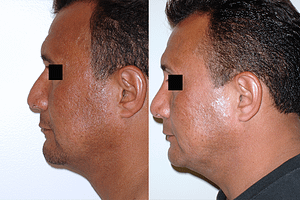 Rhinoplasty Before & After Photos Left