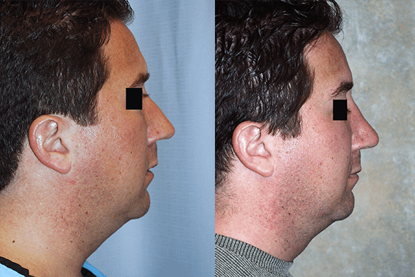 Rhinoplasty Before & After Photos