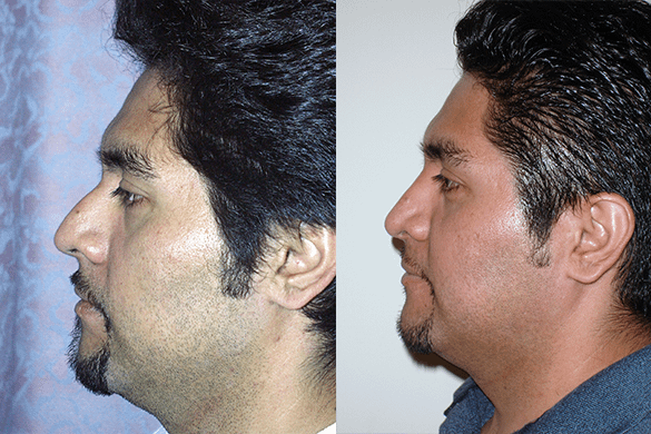 Rhinoplasty Before & After Photos Left