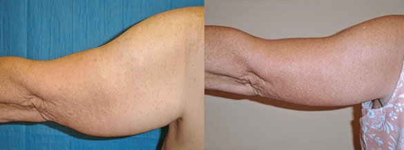 arm lift Before & After Photos