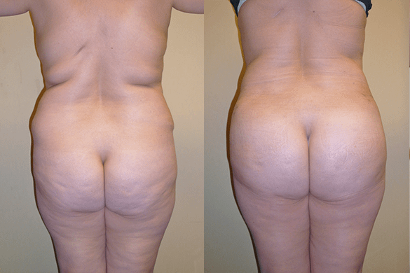 Buttock Augmentation Before & After Photos