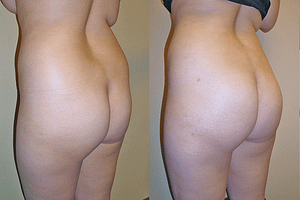 Brazilian Butt Lift Before & After Photos