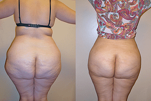 Buttock Augmentation Before & After Photos