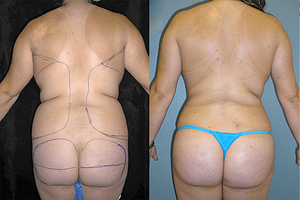 Buttock Augmentation Before & After Photos