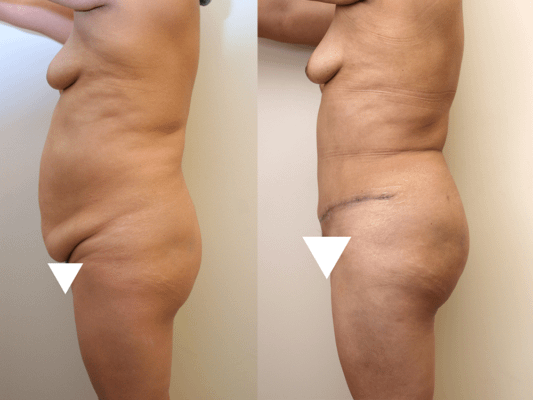 Brazilian Butt Lift Before & After Photos Left Side