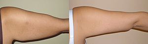 arm lift Before & After Photos