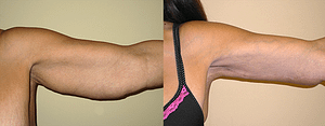 Arm Lift Before & After Photos Right