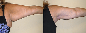 Arm Lift Before & After Photos Right