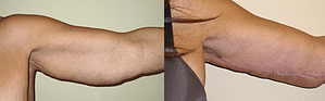 arm lift Before & After Photos