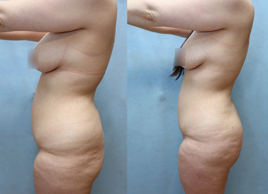 Brazilian Butt Lift Before & After Photos