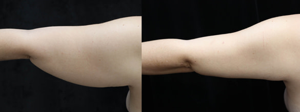 patient before and after arm lift surgery