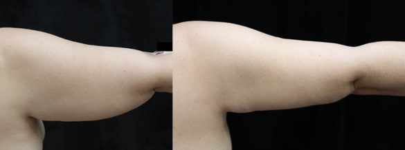 patient before and after arm lift surgery