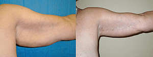 arm lift Before & After Photos