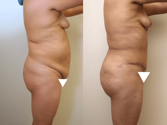 Brazilian Butt Lift Before & After Photos Right Side