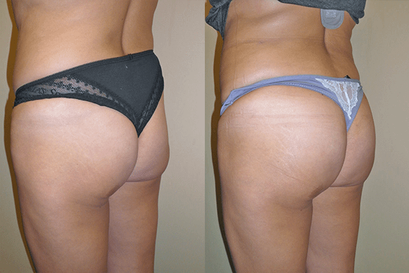 brazilian butt lift Before & After Photos