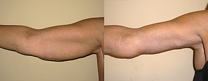 Arm Lift Before & After Photos Left