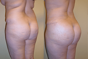 Buttock Augmentation Before & After Photos