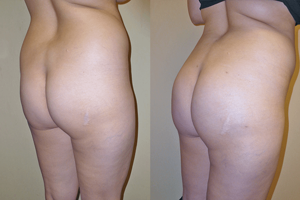 Brazilian Butt Lift Before & After Photos