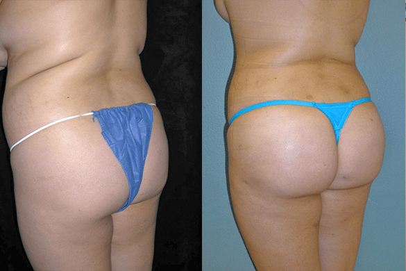 Brazilian Butt Lift Before & After Photos