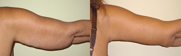 arm lift Before & After Photos