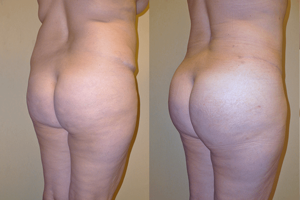 Buttock Augmentation Before & After Photos