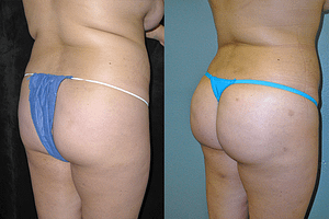 Brazilian Butt Lift Before & After Photos