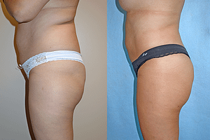 brazilian butt lift Before & After Photos
