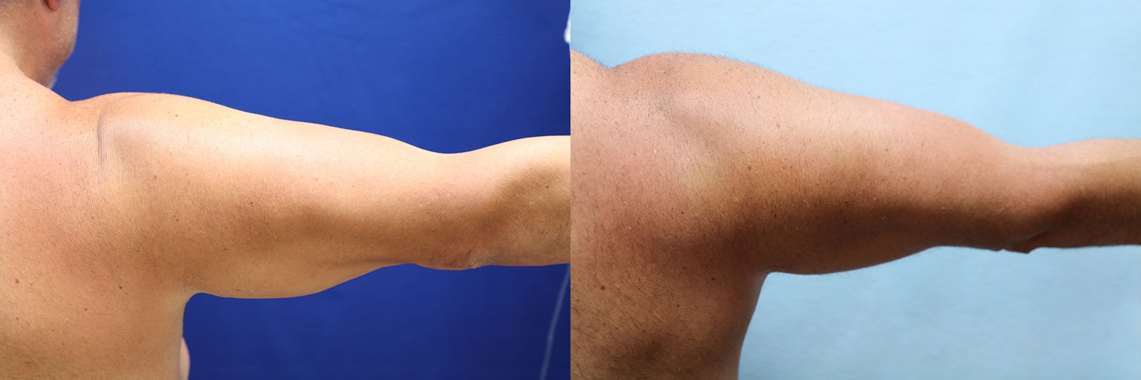 patient before and after arm lift surgery
