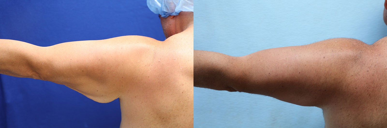patient before and after arm lift surgery