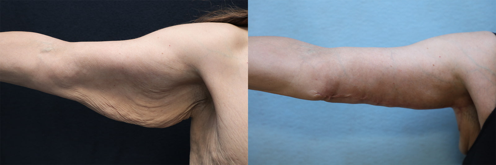 patient before and after arm lift surgery
