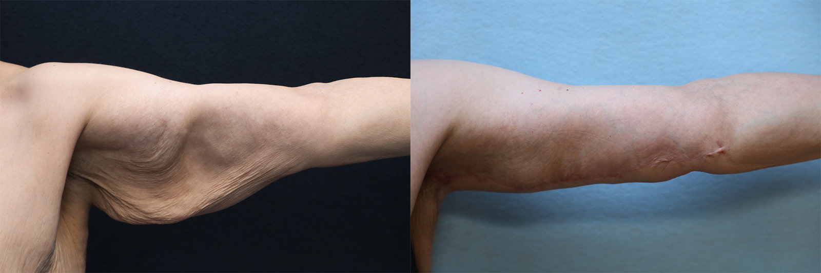 patient before and after arm lift surgery
