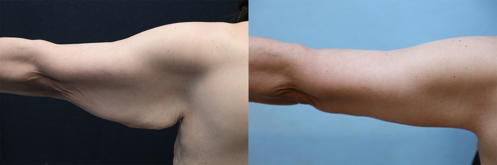 patient before and after arm lift surgery