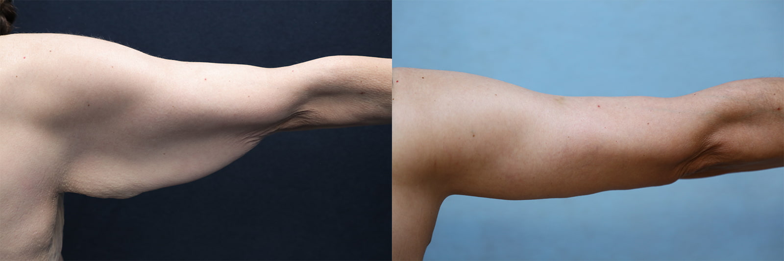 patient before and after arm lift surgery