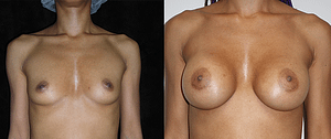 Breast Augmentation Before & After Photos Front