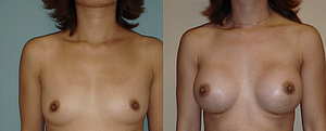 Breast Augmentation Before & After Photos