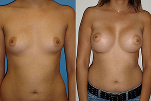 Breast Augmentation Before & After Photos